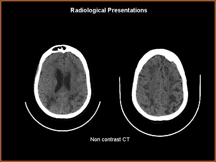 Radiological Presentations Non contrast CT 