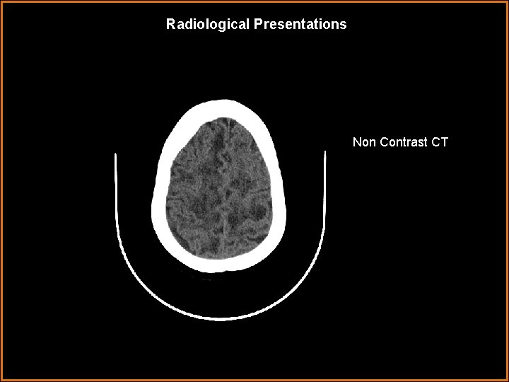 Radiological Presentations Non contrast CT Non Contrast CT 
