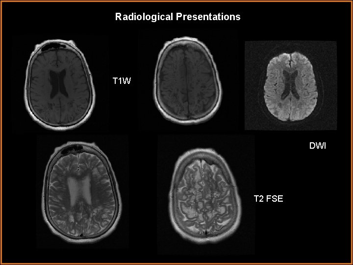 Radiological Presentations T 1 W DWI T 2 FSE 