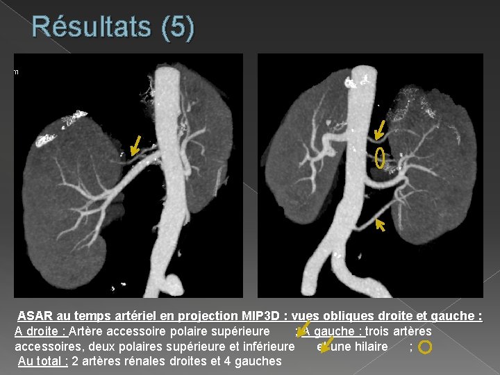 Résultats (5) ASAR au temps artériel en projection MIP 3 D : vues obliques