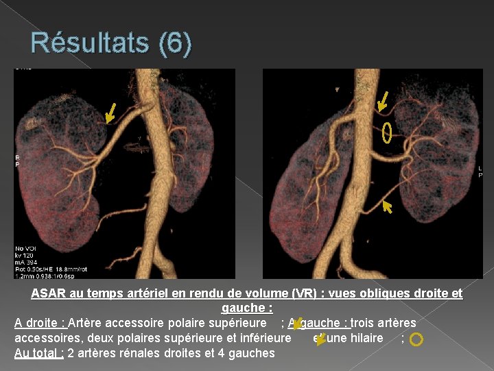 Résultats (6) ASAR au temps artériel en rendu de volume (VR) : vues obliques