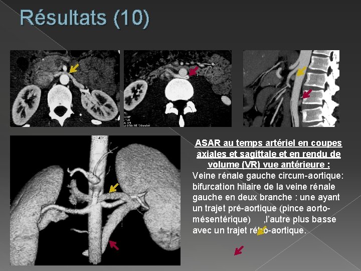 Résultats (10) ASAR au temps artériel en coupes axiales et sagittale et en rendu