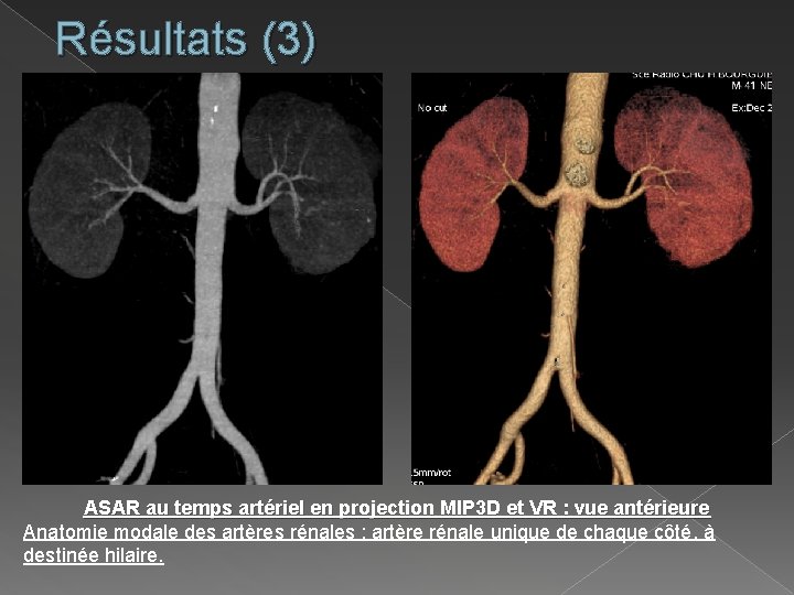 Résultats (3) ASAR au temps artériel en projection MIP 3 D et VR :