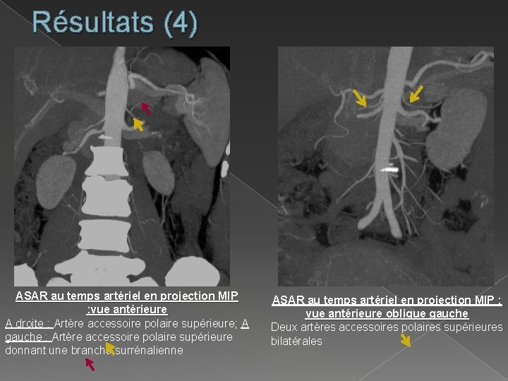 Résultats (4) ASAR au temps artériel en projection MIP : vue antérieure A droite