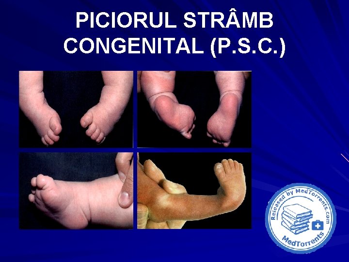 PICIORUL STR MB CONGENITAL (P. S. C. ) 