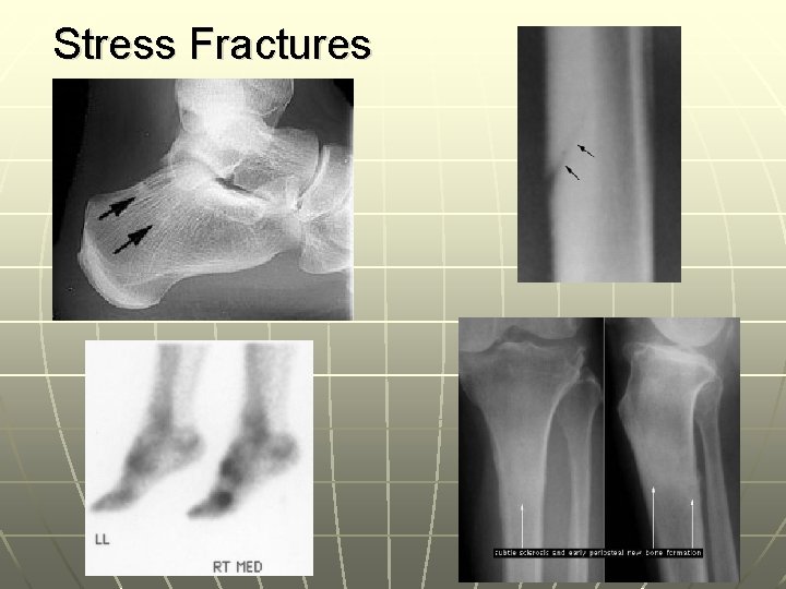 Stress Fractures 