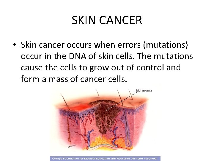 SKIN CANCER • Skin cancer occurs when errors (mutations) occur in the DNA of