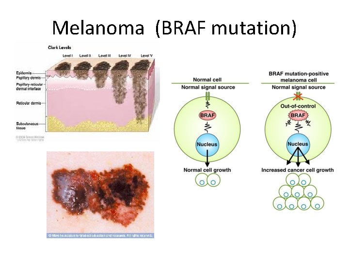 Melanoma (BRAF mutation) 