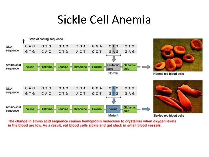 Sickle Cell Anemia 