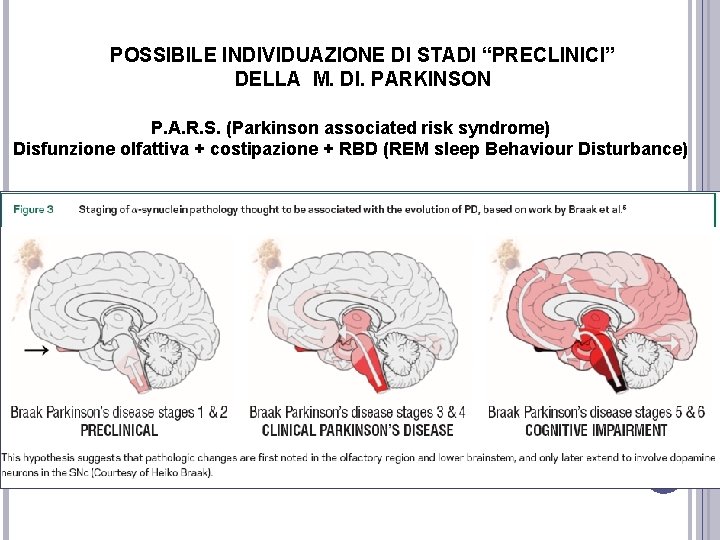 POSSIBILE INDIVIDUAZIONE DI STADI “PRECLINICI” DELLA M. DI. PARKINSON P. A. R. S. (Parkinson POSSIBILE INDIVIDUAZIONE DI STADI “PRECLINICI” DELLA M. DI. PARKINSON P. A. R. S. (Parkinson