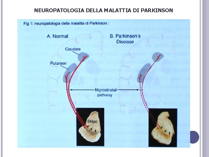 NEUROPATOLOGIA DELLA MALATTIA DI PARKINSON NEUROPATOLOGIA DELLA MALATTIA DI PARKINSON