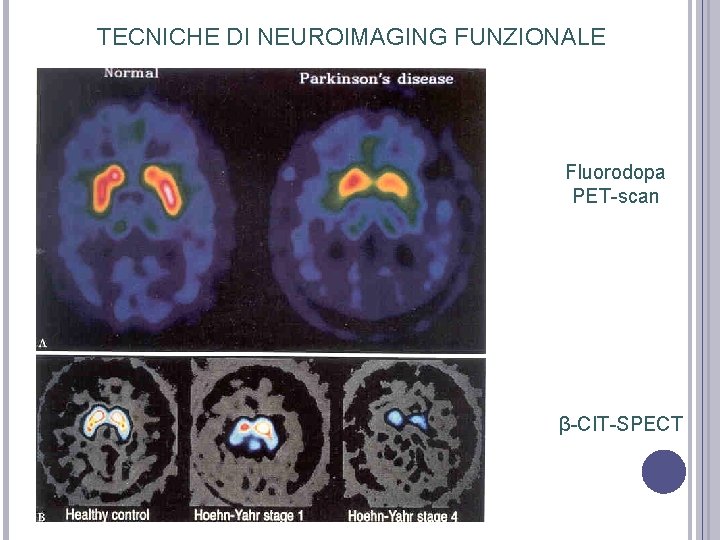 TECNICHE DI NEUROIMAGING FUNZIONALE Fluorodopa PET-scan β-CIT-SPECT TECNICHE DI NEUROIMAGING FUNZIONALE Fluorodopa PET-scan β-CIT-SPECT