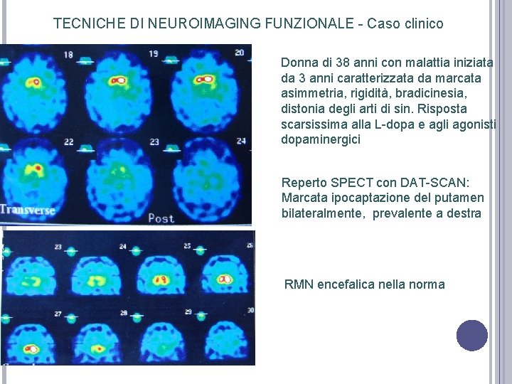 TECNICHE DI NEUROIMAGING FUNZIONALE - Caso clinico Donna di 38 anni con malattia iniziata TECNICHE DI NEUROIMAGING FUNZIONALE - Caso clinico Donna di 38 anni con malattia iniziata