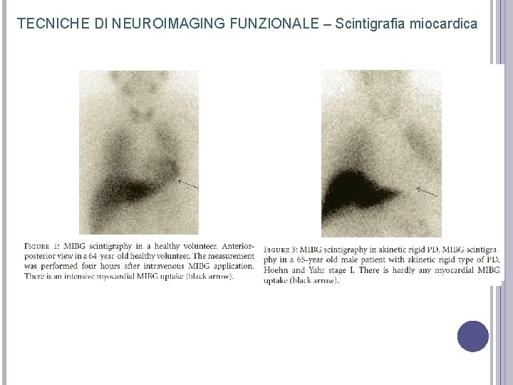 TECNICHE DI NEUROIMAGING FUNZIONALE – Scintigrafia miocardica TECNICHE DI NEUROIMAGING FUNZIONALE – Scintigrafia miocardica