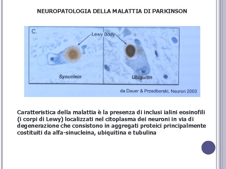 NEUROPATOLOGIA DELLA MALATTIA DI PARKINSON Caratteristica della malattia è la presenza di inclusi ialini NEUROPATOLOGIA DELLA MALATTIA DI PARKINSON Caratteristica della malattia è la presenza di inclusi ialini