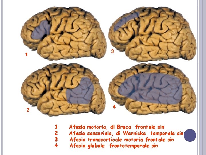 1 2 3 4 Lesoni nelle diverse forme di afasia 1 Afasia motoria, di 1 2 3 4 Lesoni nelle diverse forme di afasia 1 Afasia motoria, di