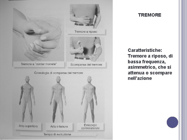 TREMORE Caratteristiche: Tremore a riposo, di bassa frequenza, asimmetrico, che si attenua o scompare TREMORE Caratteristiche: Tremore a riposo, di bassa frequenza, asimmetrico, che si attenua o scompare