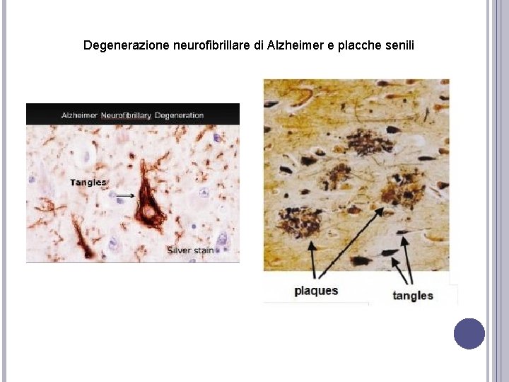 Degenerazione neurofibrillare di Alzheimer e placche senili Degenerazione neurofibrillare di Alzheimer e placche senili