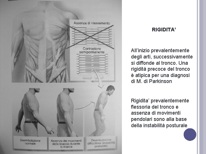 RIGIDITA’ All’inizio prevalentemente degli arti, successivamente si diffonde al tronco. Una rigidità precoce del RIGIDITA’ All’inizio prevalentemente degli arti, successivamente si diffonde al tronco. Una rigidità precoce del