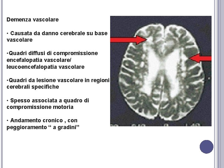 Demenza vascolare • Causata da danno cerebrale su base vascolare • Quadri diffusi di Demenza vascolare • Causata da danno cerebrale su base vascolare • Quadri diffusi di