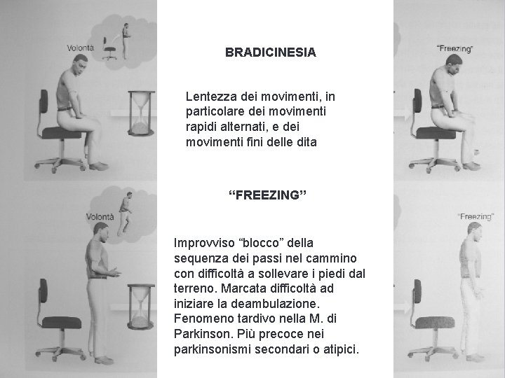 BRADICINESIA Lentezza dei movimenti, in particolare dei movimenti rapidi alternati, e dei movimenti fini BRADICINESIA Lentezza dei movimenti, in particolare dei movimenti rapidi alternati, e dei movimenti fini