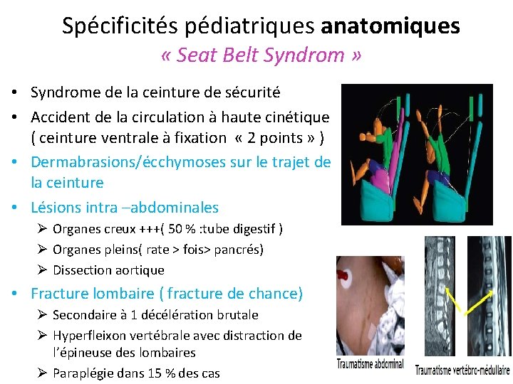 Spécificités pédiatriques anatomiques « Seat Belt Syndrom » • Syndrome de la ceinture de