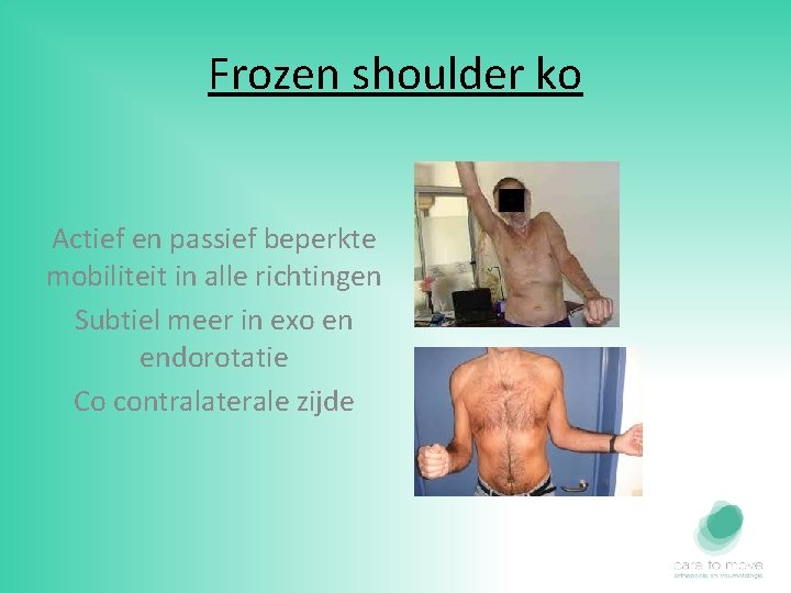 Frozen shoulder ko Actief en passief beperkte mobiliteit in alle richtingen Subtiel meer in