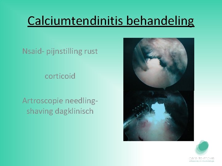 Calciumtendinitis behandeling Nsaid- pijnstilling rust corticoid Artroscopie needlingshaving dagklinisch 