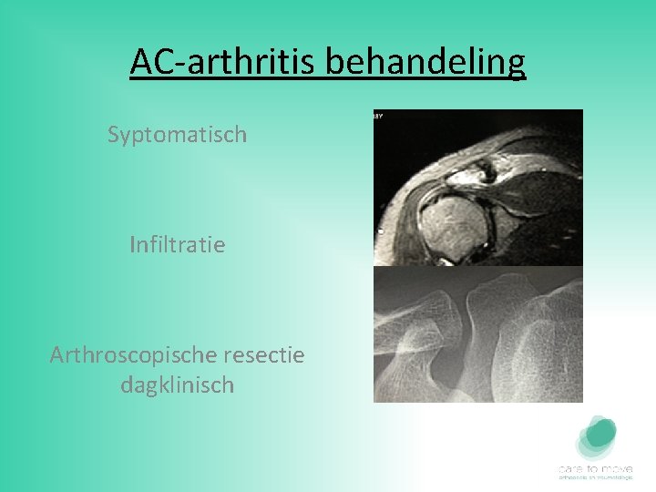 AC-arthritis behandeling Syptomatisch Infiltratie Arthroscopische resectie dagklinisch 