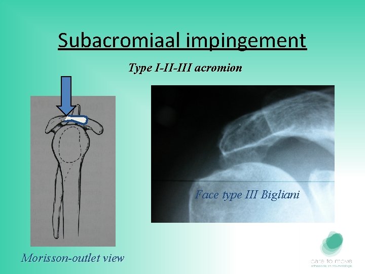 Subacromiaal impingement Type I-II-III acromion Face type III Bigliani Morisson-outlet view 