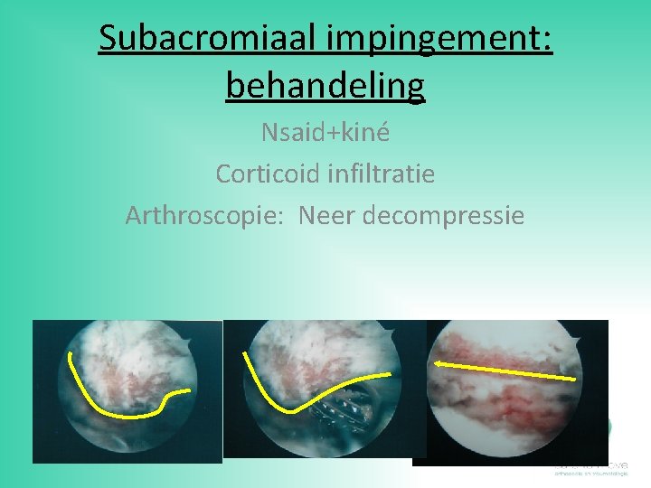 Subacromiaal impingement: behandeling Nsaid+kiné Corticoid infiltratie Arthroscopie: Neer decompressie 