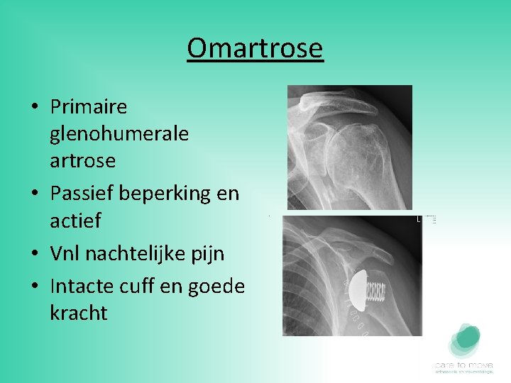 Omartrose • Primaire glenohumerale artrose • Passief beperking en actief • Vnl nachtelijke pijn