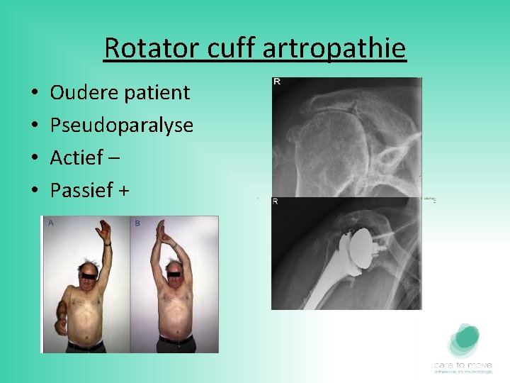 Rotator cuff artropathie • • Oudere patient Pseudoparalyse Actief – Passief + 