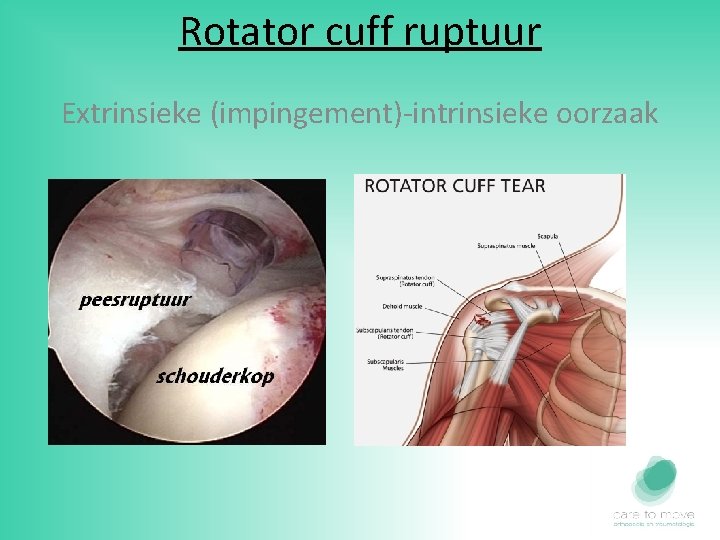 Rotator cuff ruptuur Extrinsieke (impingement)-intrinsieke oorzaak 