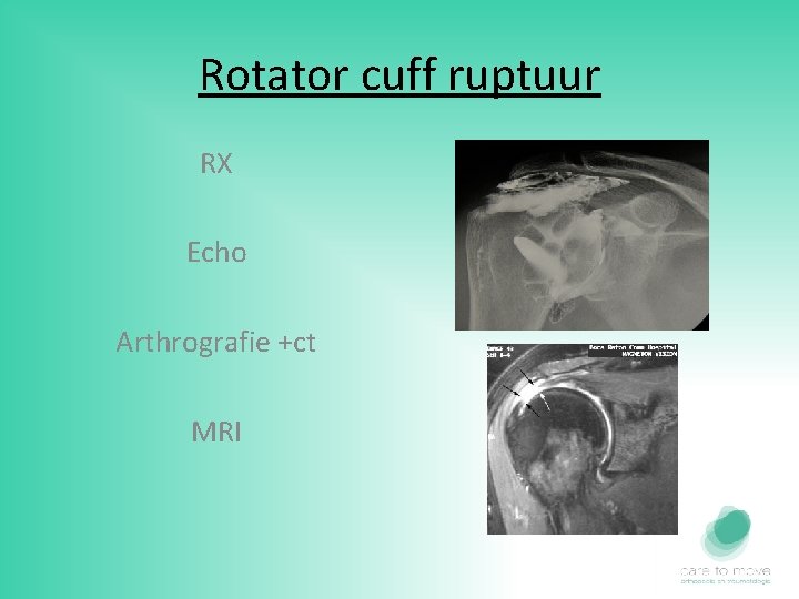 Rotator cuff ruptuur RX Echo Arthrografie +ct MRI 