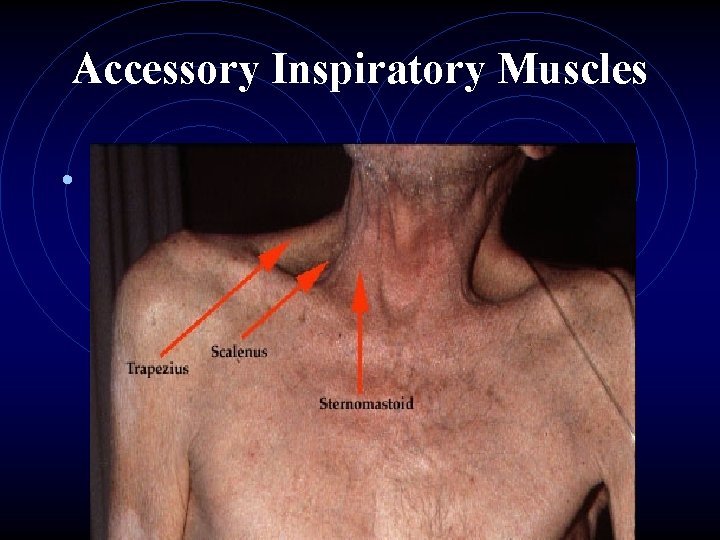 Accessory Inspiratory Muscles • 