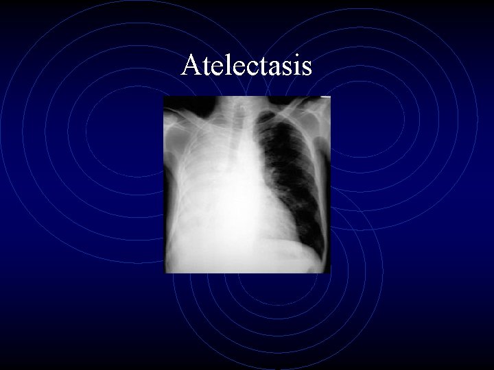 Atelectasis 