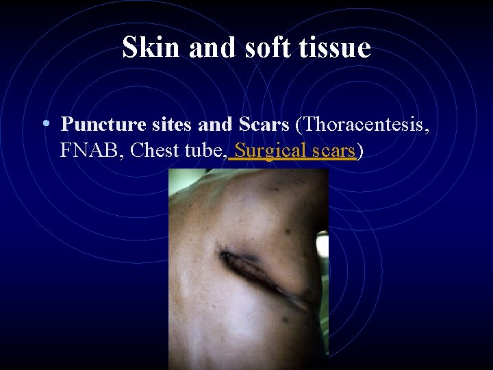 Skin and soft tissue • Puncture sites and Scars (Thoracentesis, FNAB, Chest tube, Surgical