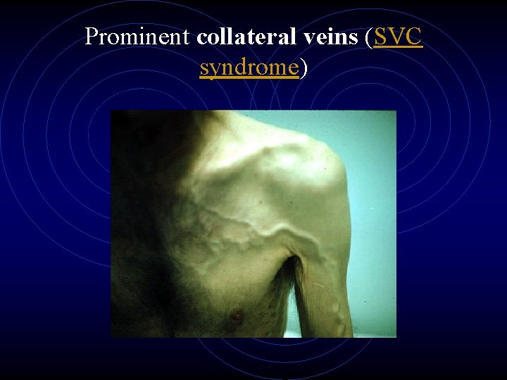 Prominent collateral veins (SVC syndrome) 