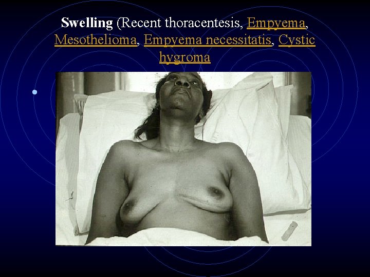 Swelling (Recent thoracentesis, Empyema, Mesothelioma, Empyema necessitatis, Cystic hygroma • 