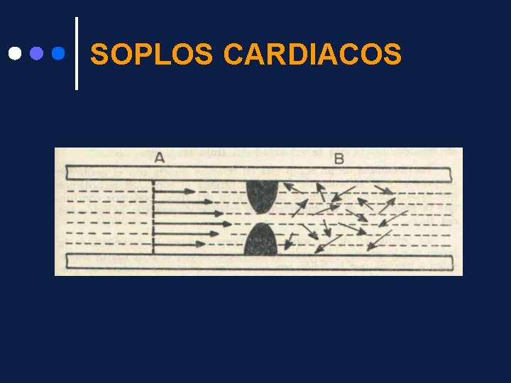 SOPLOS CARDIACOS 