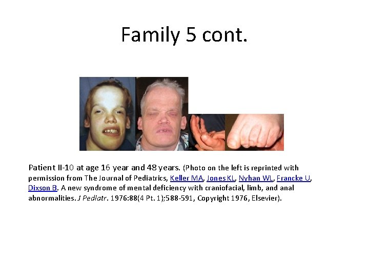 Family 5 cont. Patient II-10 at age 16 year and 48 years. (Photo on