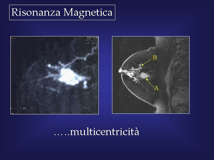 Risonanza Magnetica …. . multicentricità 