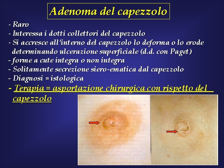 Adenoma del capezzolo - Raro - Interessa i dotti collettori del capezzolo - Si