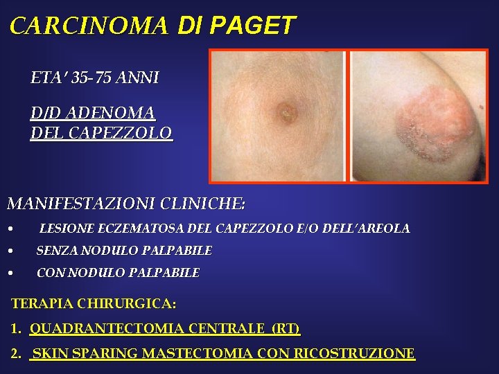CARCINOMA DI PAGET ETA’ 35 -75 ANNI D/D ADENOMA DEL CAPEZZOLO MANIFESTAZIONI CLINICHE: •