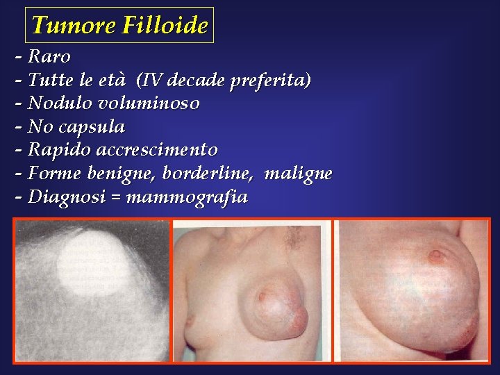 Tumore Filloide - Raro - Tutte le età (IV decade preferita) - Nodulo voluminoso