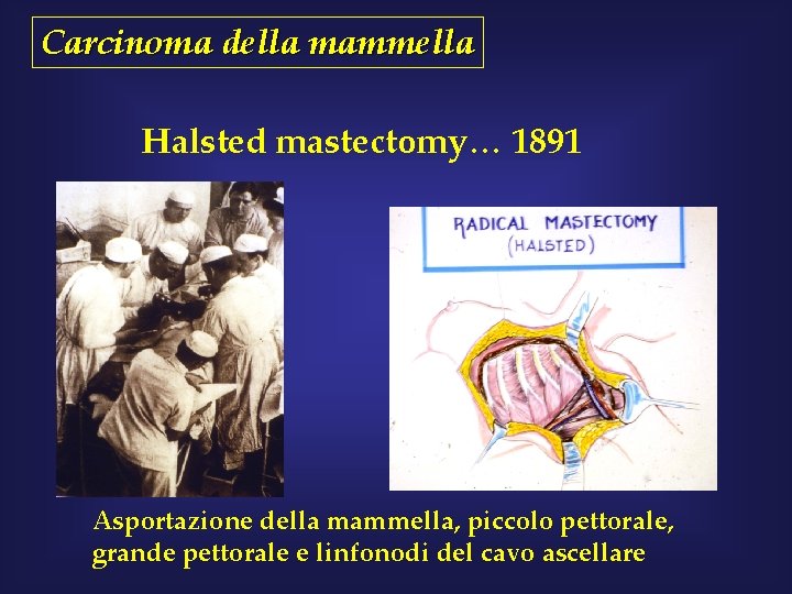 Carcinoma della mammella Halsted mastectomy… 1891 Asportazione della mammella, piccolo pettorale, grande pettorale e