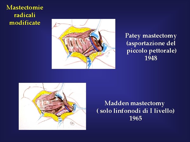 Mastectomie radicali modificate Patey mastectomy (asportazione del piccolo pettorale) 1948 Madden mastectomy ( solo