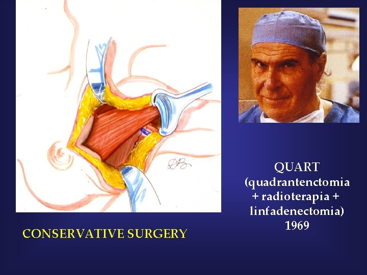 CONSERVATIVE SURGERY QUART (quadrantenctomia + radioterapia + linfadenectomia) 1969 