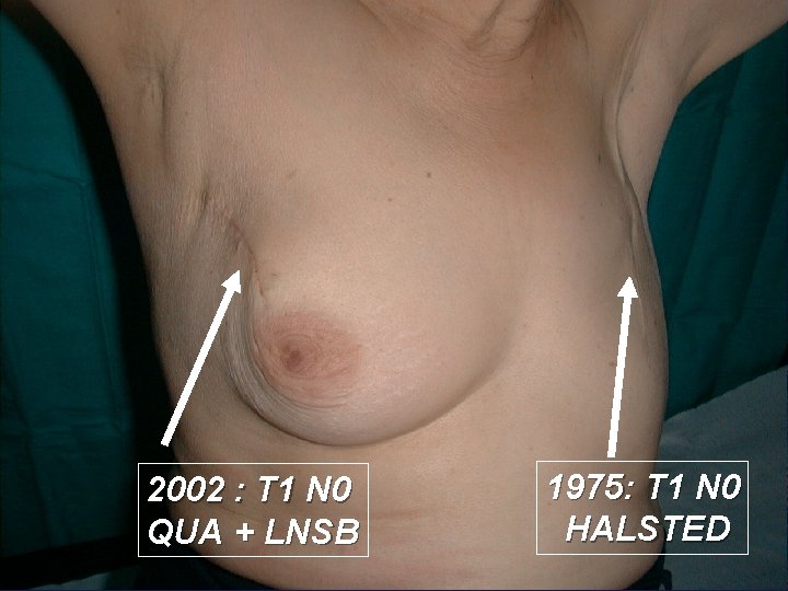 2002 : T 1 N 0 QUA + LNSB 1975: T 1 N 0